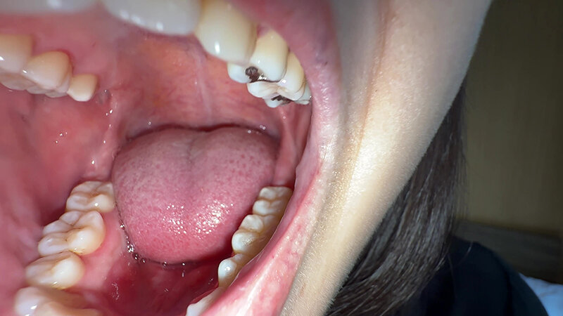 「【湊波流】素人お姉さんをナンパ!舌ブラシで汚舌苔採取する個人撮影動画」のサンプル画像9枚目